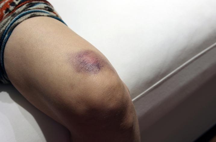 3 kinds of injuries that can trigger a DCFS investigation